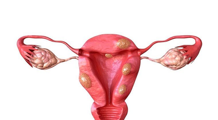 Miomatosis uterina