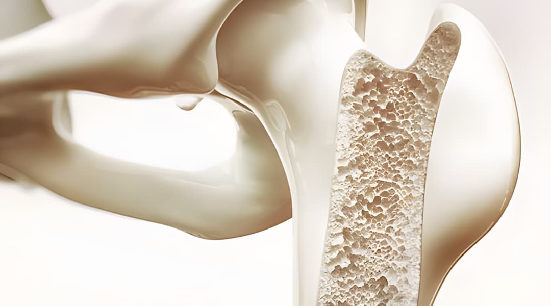 Osteoporosis