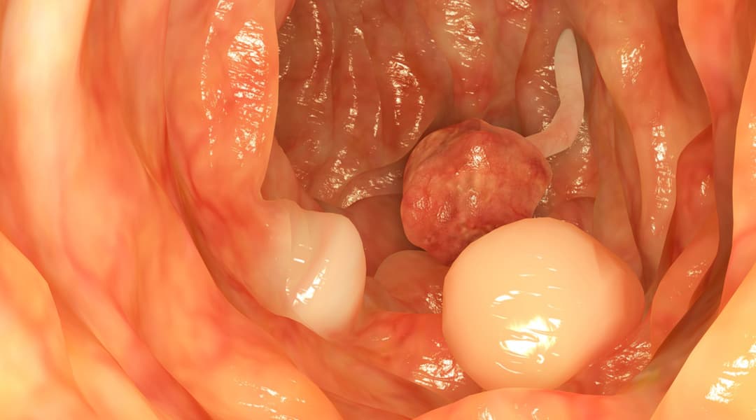 Pólipos endometriales