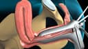Biopsia ginecológica y transoperatoria