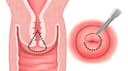 Conización cervical