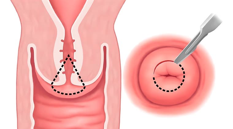 Conización cervical