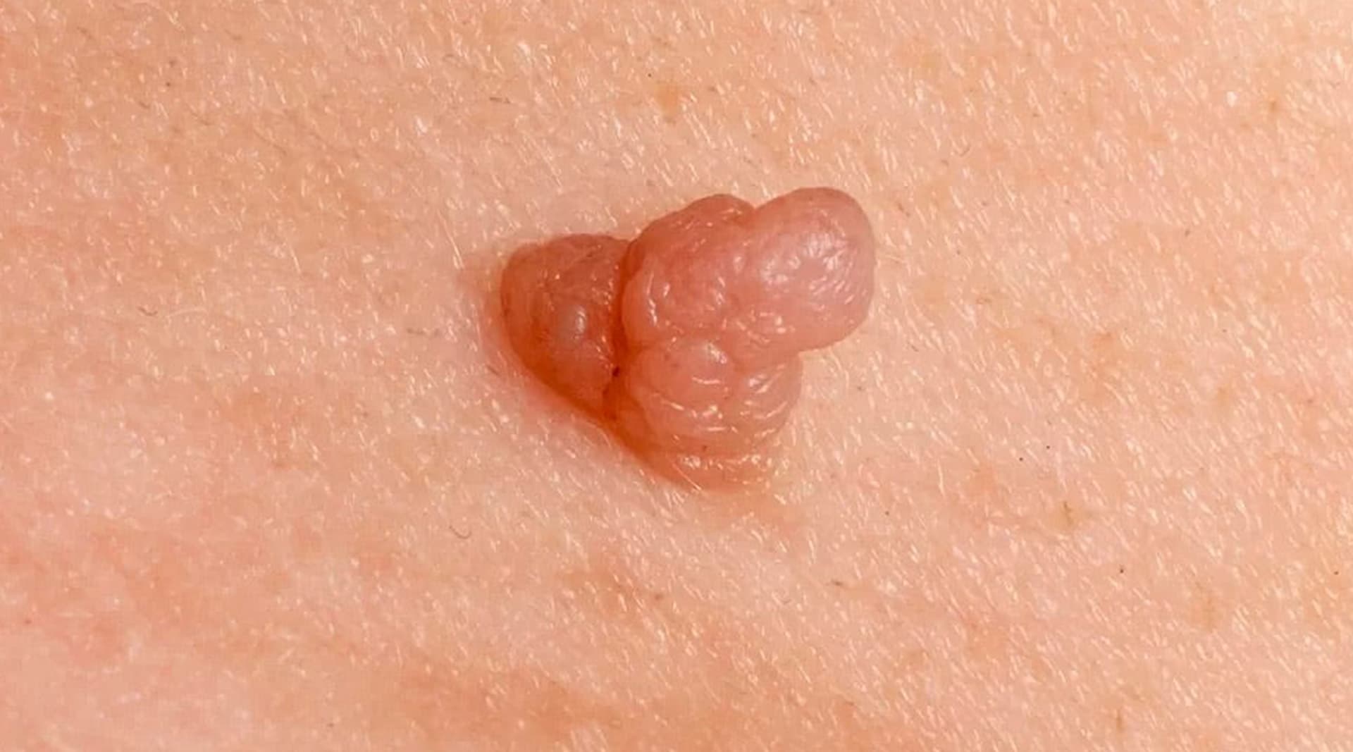 Tratamiento de verrugas genitales